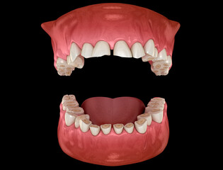 Dental attrition (Bruxism) resulting in loss of tooth tissue. Dental 3D illustration
