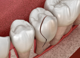 Cracked tooth, splitted. Dental 3D illustration - 502383464