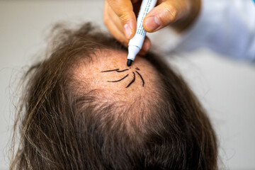 Closeup of woman's hands working for hair transplant preparation on man's head