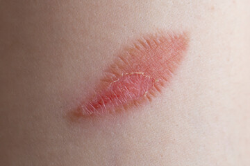 Leaf shaped burn wound on a woman's fore arm, macro skin texture