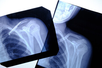 Two X ray images man with fractured collarbone and an inserted space after surgery.