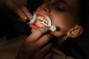 Plastic retractor for lip augmentation in the mouth, dental procedure and retractor as an auxiliary element.