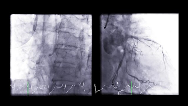 Cardiac catheterization is a test used to find out  cardiac arrest .