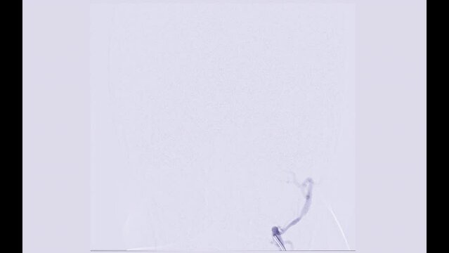 Cerebral angiography  from Fluoroscopy in intervention radiology  showing cerebral artery for diagnosis cerebral artery aneurysm.