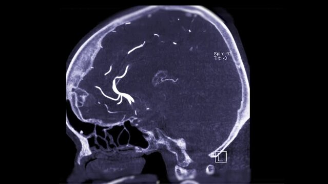 Cerebral angiography  from Fluoroscopy in intervention radiology  showing cerebral artery for diagnosis cerebral artery aneurysm.