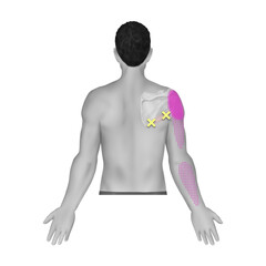 대원근 트리거포인트 통증유발점