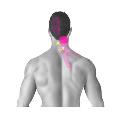 경반극근 다열근 트리거포인트 통증유발점