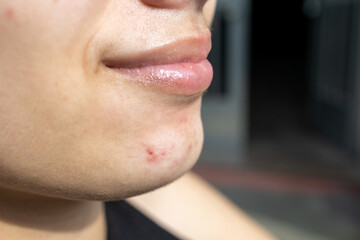 Adolescent with juvenile acne on the face