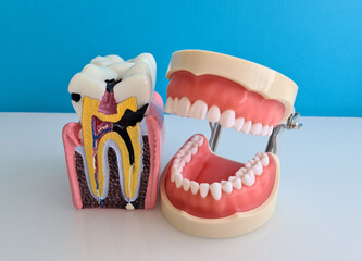 Tooth with caries and dental jaw model closeup