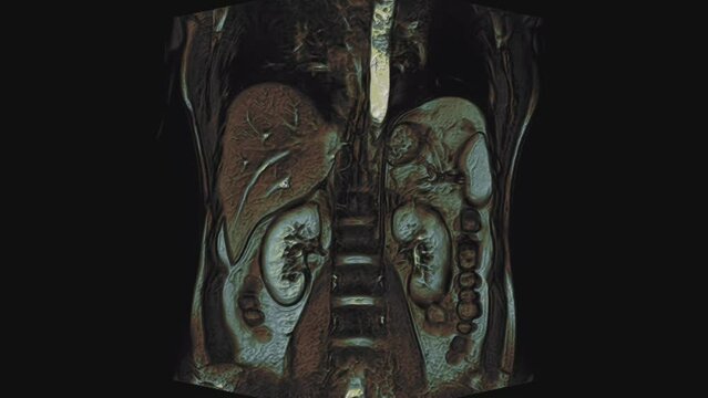 Bulk multicolored CT scan of the abdomen. Computed tomography of the gastrointestinal tract, liver and kidneys