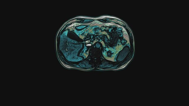 Bulk multicolored CT scan of the abdomen. Computed tomography of the gastrointestinal tract, liver and kidneys