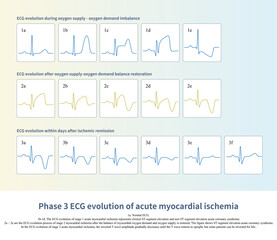 The pathological process of acute myocardial ischemia is different under different physiological conditions. Doctors can understand the clinical course of patients according to ECG.