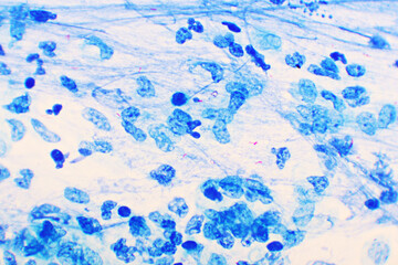 Mycobacterium tuberculosis positive (small red rod) in sputum smear, acid-fast stain, analyze by...