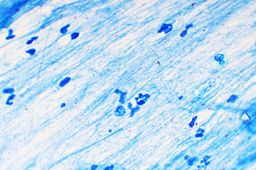 Mycobacterium tuberculosis positive (small red rod) in sputum smear, acid-fast stain, analyze by microscope 1000x