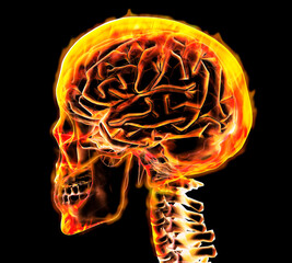 Close-up of an X-Ray image of human skull representing headache