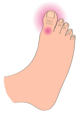 Close-up of foot with gout