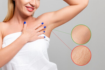 Young smiling woman showing the smooth skin of her armpits. Enlarged area with results before and...