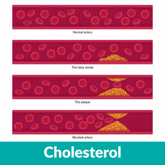 Scheme of clogged artery development with visualized blood stream