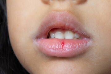 Naklejka premium Girl dry lips with open cracks and blood