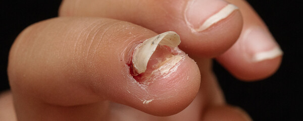 Finger nail come-off after injury or disease - obrazy, fototapety, plakaty