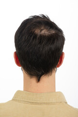 Nape of a young man with baldness principle