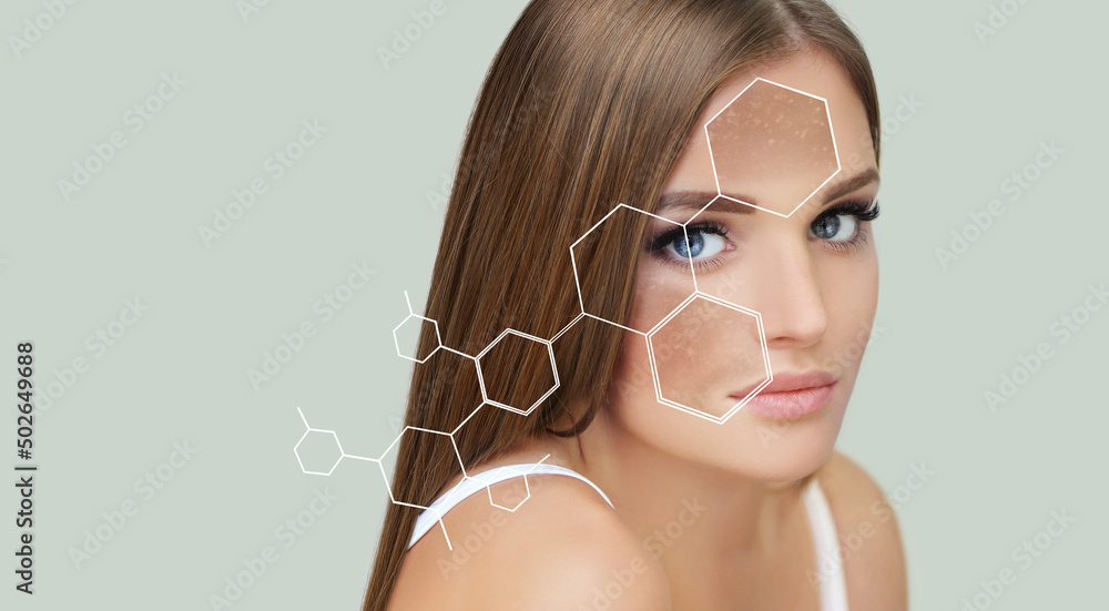 Wall mural Dark spots, freckles,hyperpigmentation(melasma or chloasma),concept - skin lightening, skin whitening, fruit acids,AHA, Skin Brightening.