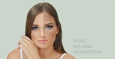 Dark spots, freckles,hyperpigmentation(melasma or chloasma),concept - skin lightening, skin...