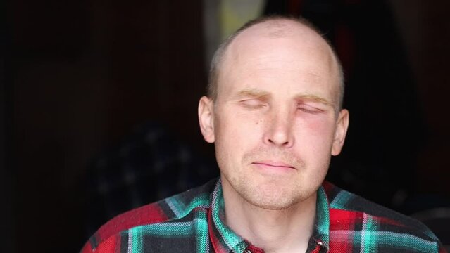Swollen face after a bee sting