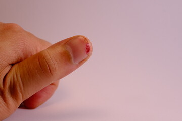 Thumb was cut off with a knife. close-up of a wound.