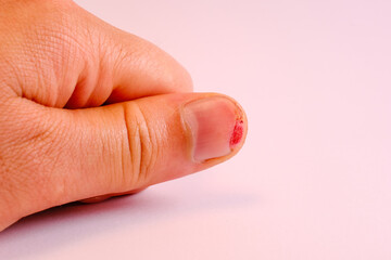Thumb was cut off with a knife. close-up of a wound.