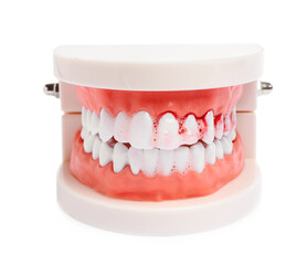 Model of jaw and toothpaste foam with blood on white background. Gum problems