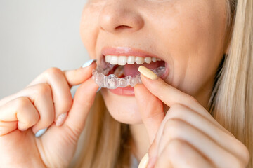 Close-up portrait of a woman putting on a transparent plastic retainer. A girl corrects a bite with...