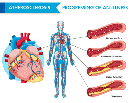 Atherosclerosis progression of an illness
