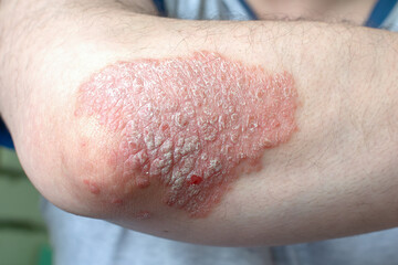 A huge spot of psoriasis on the elbow.Exacerbation of the disease