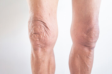 Leg and knee of an old man with synovial problems on a white background.