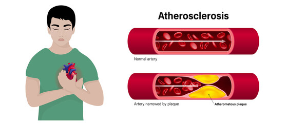 Atherosclerosis vector concept. The difference of normal artery and Artery narrowed by plaque. Coronary artery syndrome. Myocardial ischemia.