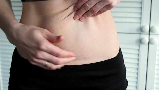 Scar on a woman belly from a caesarean section and appendicitis surgery. Hands touching the nelastic skin. Navel hernia. Deposition of the abdomen fat. Body after pregnancy. Stretch marks. Overweight.