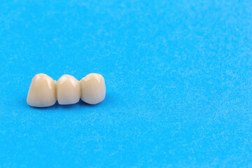 Dental ceramic bridge prosthesis on blue background.