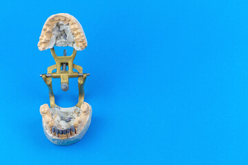 Dental occluder with plaster models of jaws and teeth. On the lower six central teeth, the frame is a fixed bridge.