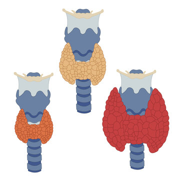thyroid gland in three states is isolated on a white background. Image of Hypothyroidism, disease for Medical centers, education. World Thyroid Day