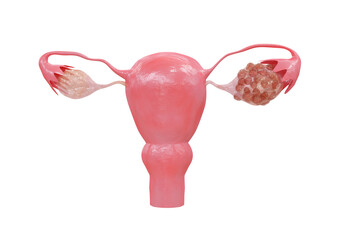 Polycystic Ovary Syndrome A hormonal disorder that causes an increase in the size of the ovaries with small cysts on the outside of the ovaries - obrazy, fototapety, plakaty