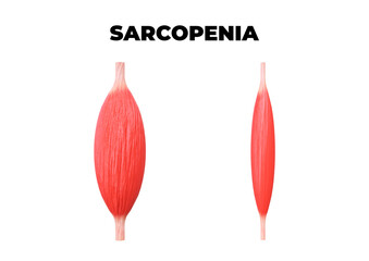 Sarcopenia is the loss of muscle mass, a common occurrence after age 50 - obrazy, fototapety, plakaty