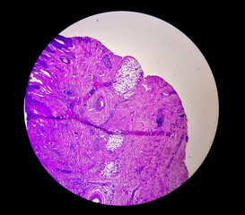 Skin Cancer: Skin biopsy under microscope showing Basal cell carcinoma.