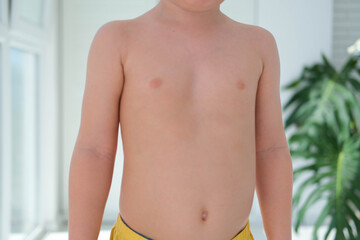 Fototapeta na wymiar A child with a pectus excavatum. Rickets is a consequence of vitamin D deficiency.