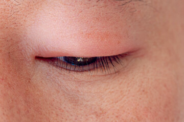 Health and skincare concept, Close up narrow-eyed asian style, Chalazion and Hordeolum (Stye) are...