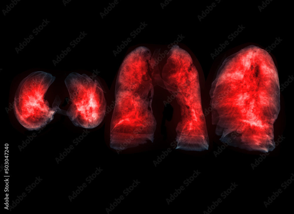Poster collection of lung 3d rendering image.