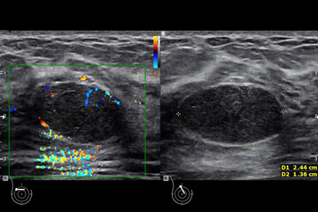 ultrasound  breast of Patient after mammogram  .