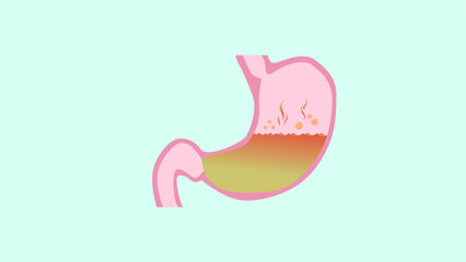 illustration of a Gerd stomach vector