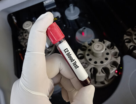 Scientist hold blood sample for E2 (estradiol) blood test, one types of estrogen.