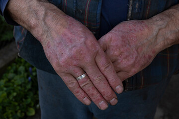 Two male male hands with signs of psoriasis